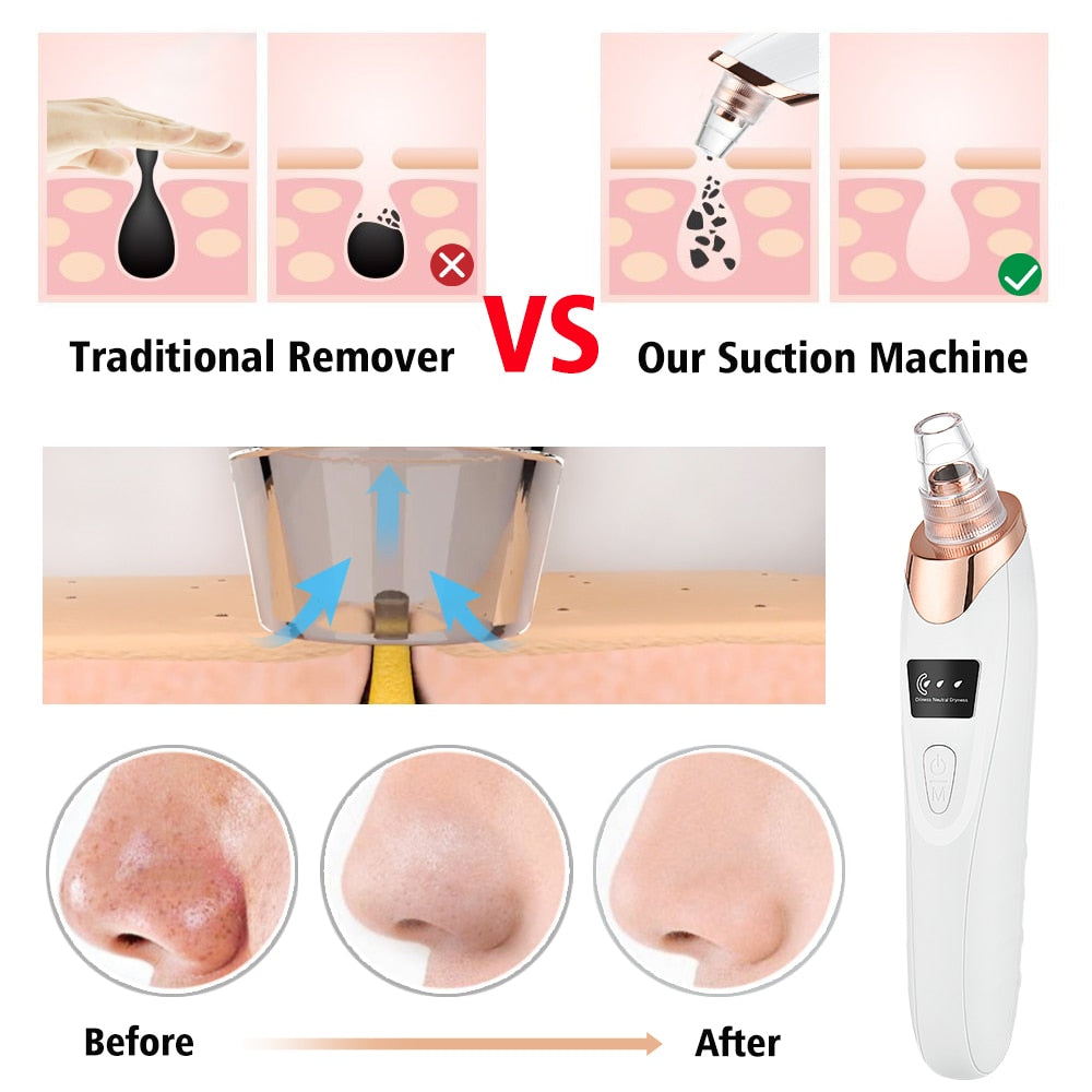 Electric Cleaning Blackhead Remover